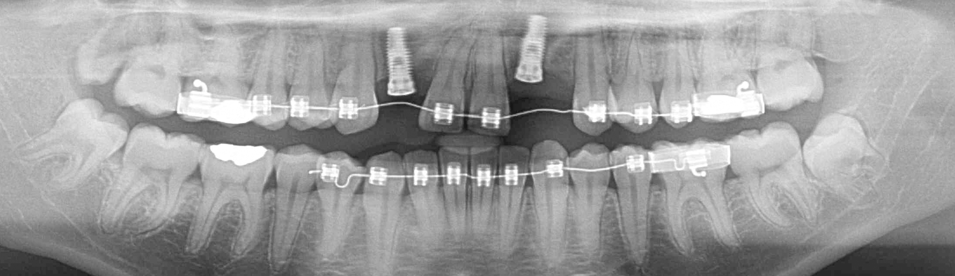 Implante Dentário: Será Que Pode Haver Rejeição?