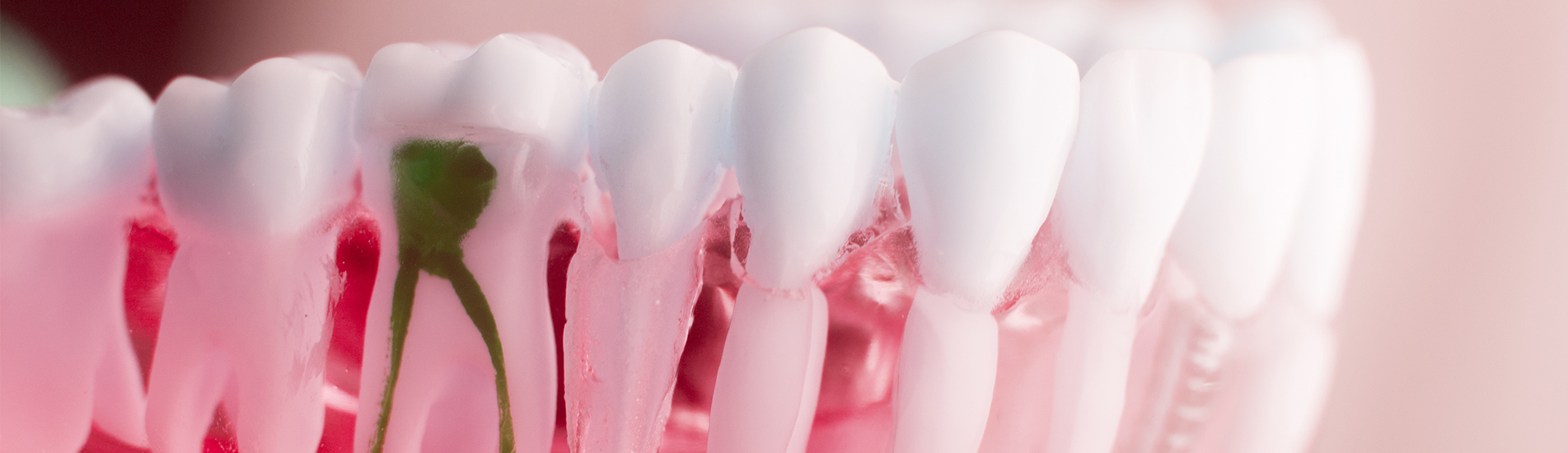 Prótese Overdenture: Entenda Mais Sobre Esse Tratamento